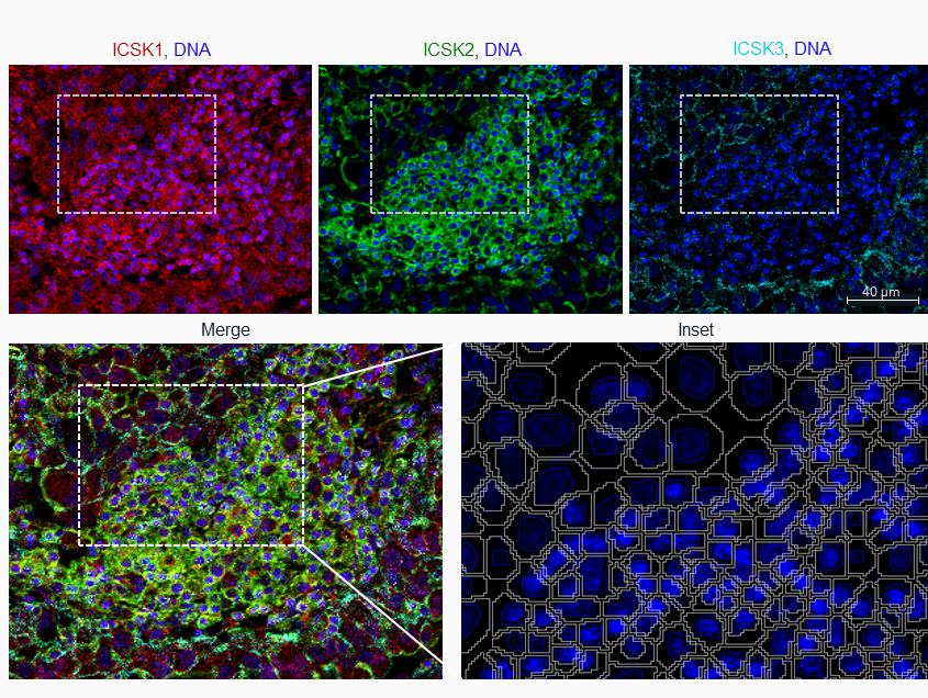 Human formalin-fixed, paraffin-embedded (FFPE) non-small-cell lung cancer stained with the Maxpar IMC Cell Segmentation Kit. Scale bar is 40 μm. Red, ICSK1; green, ICSK2; teal, ICSK3; blue, DNA stain. Cell segmentation was generated using Visiopharm® Phenoplex™ software.