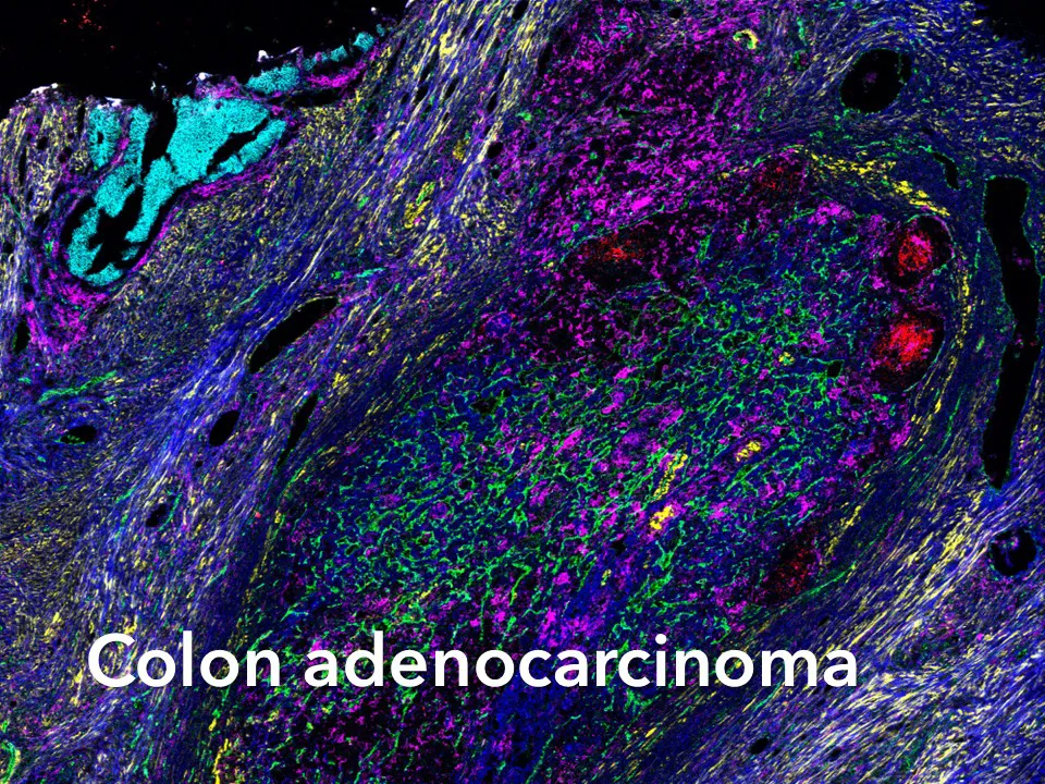 Colon Adenocarcinoma