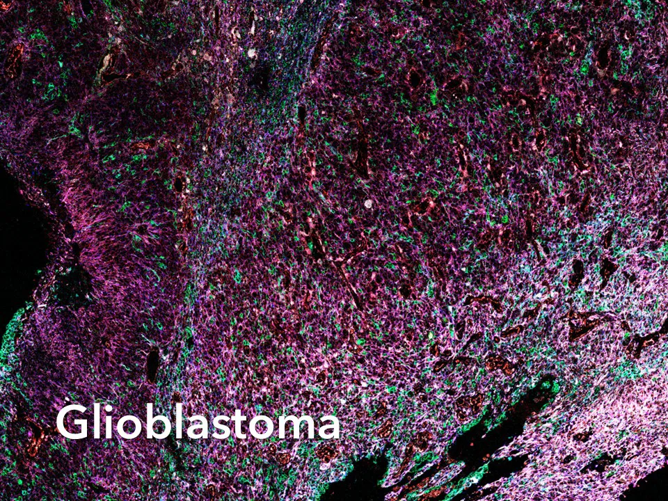Glioblastoma